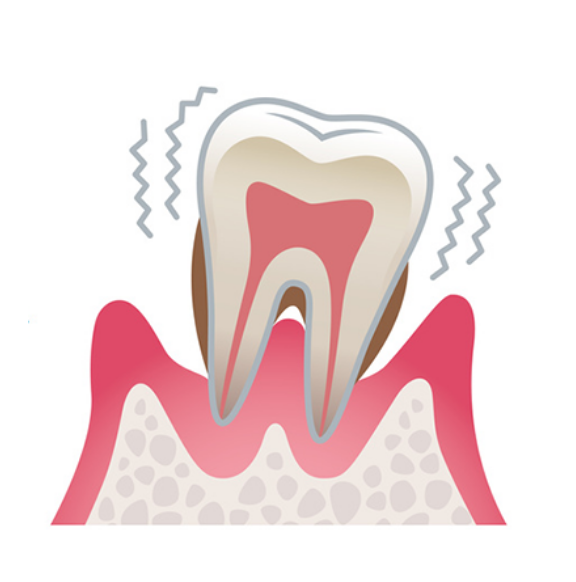 重度の歯周病