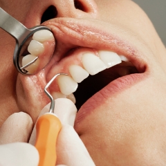 スケーリング（歯石除去）