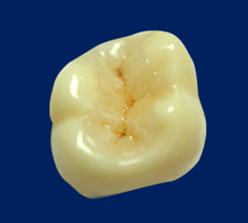 ジルコニアインレー