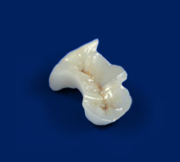 ジルコニアインレー