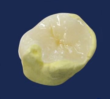 セラミックインレー