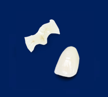 セラミックインレー