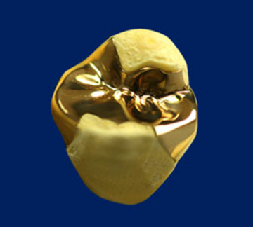 ゴールドインレー