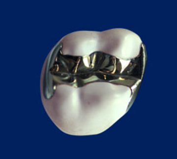 メタルインレー