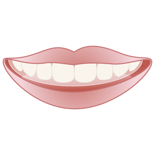 マウスピース矯正