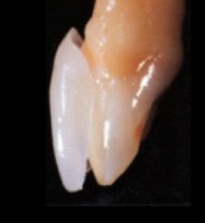 ラミネートべニア