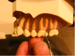 ルートプレーニング