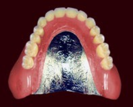 チタン床義歯