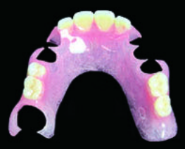 ノンクラスプデンチャー