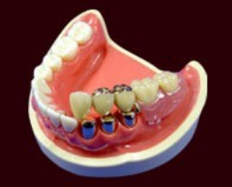 コーヌスデンチャー